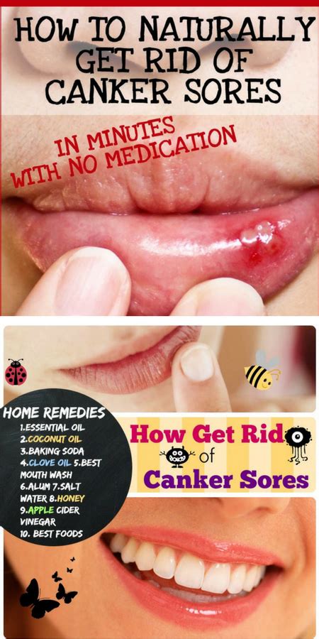 Everything You Need To Know About Canker Sores T Tapp