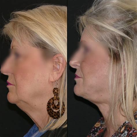 lifting du visage et du cou chirurgie esthétique paris — dr gérald franchi