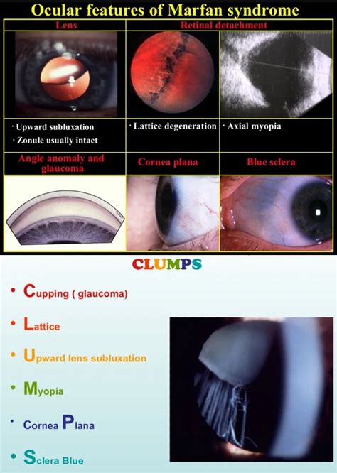 Ocular Features Of Marfan Syndrome
