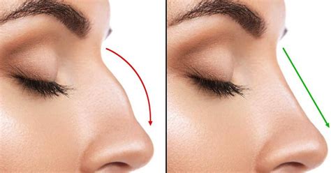 What To Expect 3 Weeks After Rhinoplasty