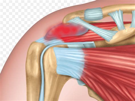 Shoulder Bursitis A Common Cause Of Shoulder Pain Orthopedic Center