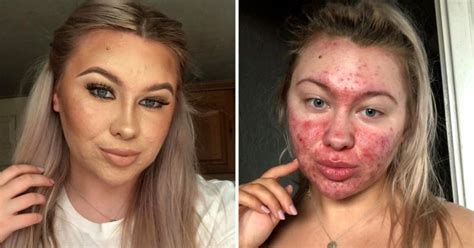 Woman With Cystic Acne Finally Feels Comfortable Going Out Without