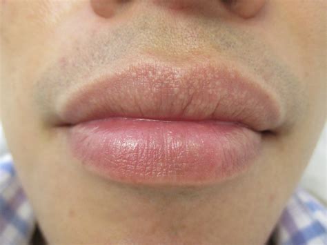 Figure 1 Fordyce Spots On The Upper Lip