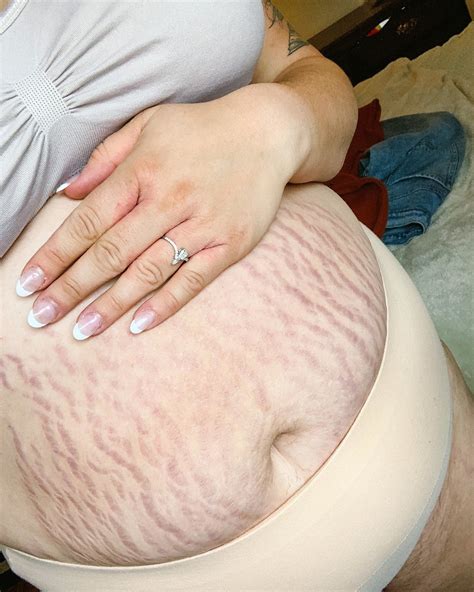 Pregnant Belly Stretch Marks