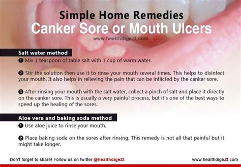 Pin By Amie Wilson Mcbride On ~ Health ~ Canker Sore Mouth Ulcers