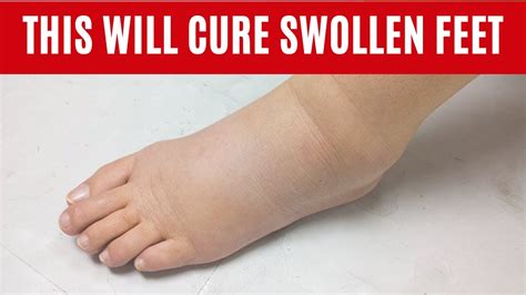 Home Remedies For Swollen Feet And Ankle Youtube