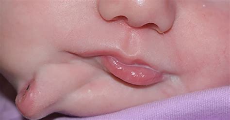 Cela peut être répété plusieurs fois sur une base quotidienne pour obtenir les meilleurs résultats. Un petit bébé vient de naitre avec deux bouches sur son visage