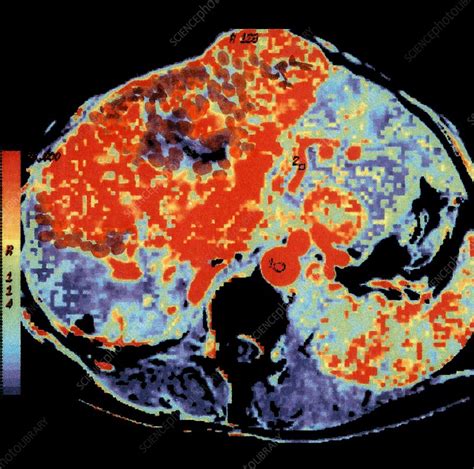 Kidney Cancer Ct Scan Stock Image C0018095 Science Photo Library