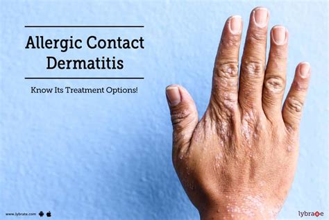 How To Get Rid Of Contact Dermatitis Distancetraffic19