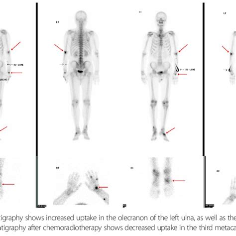 A Technetium 99m Bone Scintigraphy Shows Increased Uptake In The