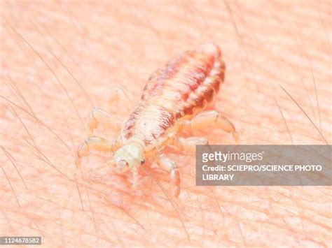 Lice Bites Photos And Premium High Res Pictures Getty Images