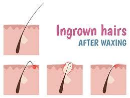 Hold on for about 10 minutes then bathe with warm water. how-to-prevent-folliculitis-occurring-after-waxing | Guys ...