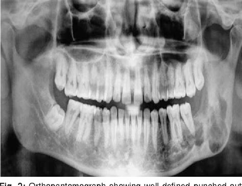 Figure 1 From Eosinophilic Granuloma Of Mandible A Report Of Two