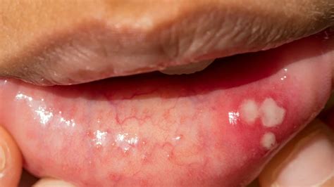 What Causes Canker Sores Utility Wall