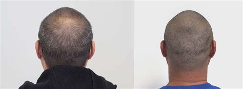 Scalp Micropigmentation Ireland - SMP Donegal - Scalp ...