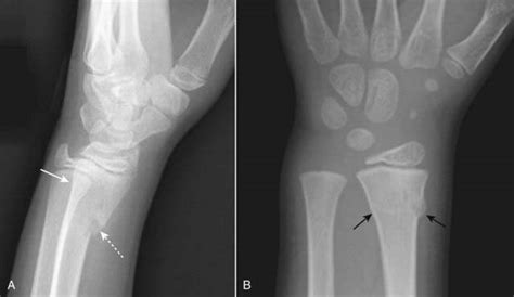 Recognizing Fractures And Dislocations Radiology Key