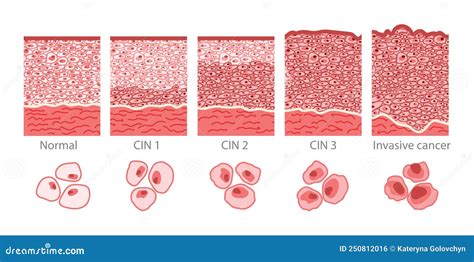 Cervical Cancer Cells Elongated Dysplasia Stages Infographic Female