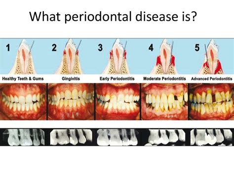 Periodontal Pockets Dentist Ballarat Dr Don Anderson