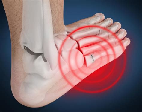 Tendonitis On Top Of Foot Neuritis And Neuromas Footeducation The