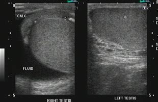 Physical examination and ultrasound are usually the first performed. Testicular ultrasound scanning - Andrology Solutions