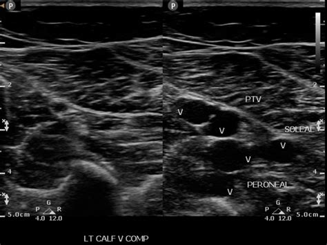 Venous Ultrasound Hands On Training Vascular Hands On Education Rvs