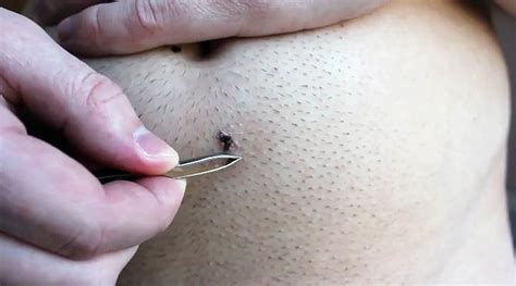 Exfoliez régulièrement votre pubis pour prévenir les poils incarnés. Poil incarné: comment s'en débarrasser