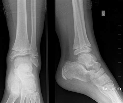 Normal Left Ankle Xray