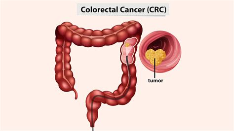 Gastrointestinal Cancers Causes Symptoms And Treatments Expert