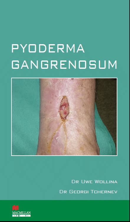 Pdf Treatment Of Pyoderma Gangrenosum