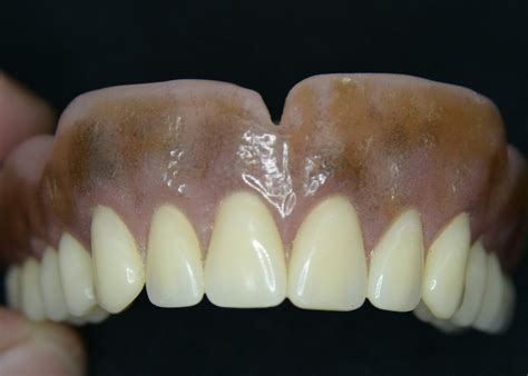Bds Complete Dentures