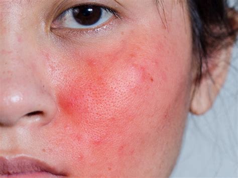 Skin Rash On Face