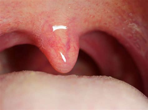 Uvulitis What Is Uvulitis