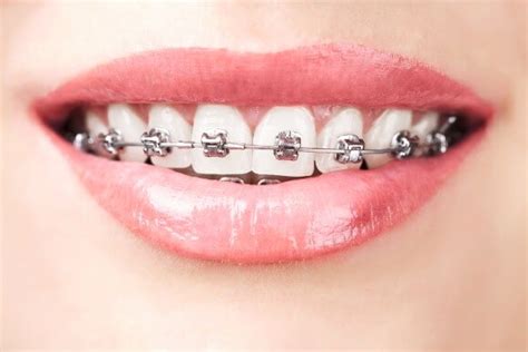 Orthodontist Canberra Dentist Canberra
