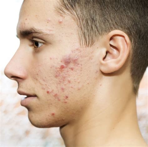 Acnepimples Catalog Fair Skin Experts