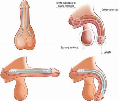 Implant Penile Malleable Penis Implants Zsi Glans