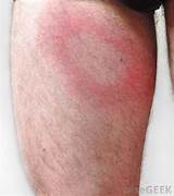 Lyme Disease Rash Itch Treatment Pictures
