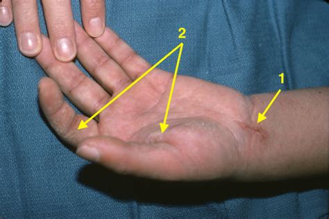 Median Nerve Laceration Hand Surgery Source