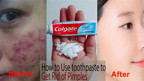 How To Use Toothpaste To Get Rid Of Pimples How To Get Rid Of Pimples How To Remove Pimples
