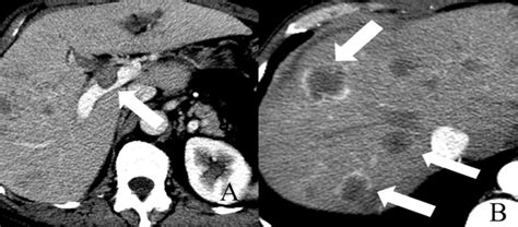 A Axial Contrast Enhanced Ct Image Shows A Stage T2 Intrahepatic