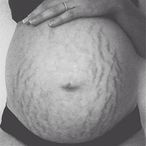 Love Your Lines Instagram Inspires Women To Love Their Stretch Marks And Gained 75000