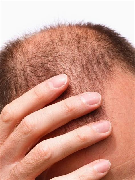 Male Hair Loss Treatment Liverpool Aesthetically You