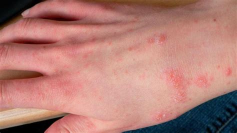 Scabies The Infuriating Insatiable Itch