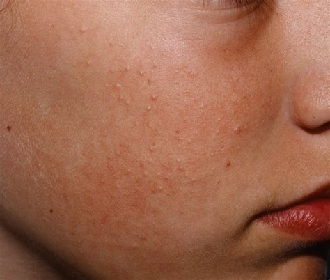 Collection Images Keratosis Pilaris On Face Pictures Full Hd K K