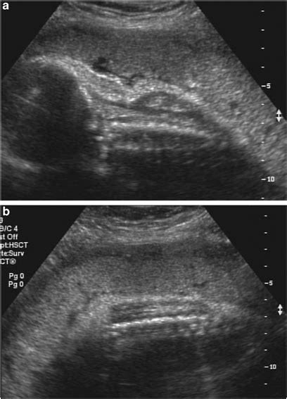 Transverse Images Of The Placenta Showing A Normal Decidualplacental