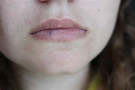 Lip Cancer Causes Symptoms And Treatments