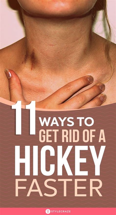 How To Get Rid Of A Hickey 13 Simple Ways How To Hide Hickeys Get