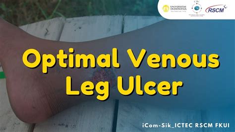 Optimal Venous Leg Ulcer Management Youtube