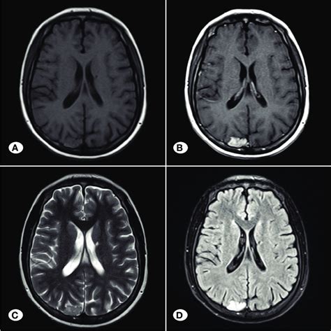 Axial T1 Weighted A Contrast Enhanced T1 Weighted B T2 Weighted