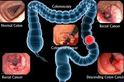 Colorectal cancer grows very slowly and signs of a tumor in the colon. Colorectal cancer - Symptoms, Signs, and Prevention