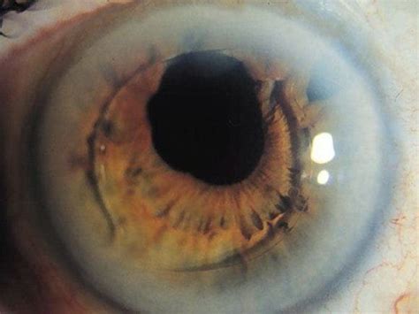 Bump And Blur Lens Dislocation Litfl Ophthalmology Befuddler